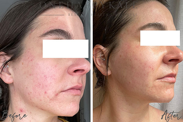 Client before and after, acne cleared