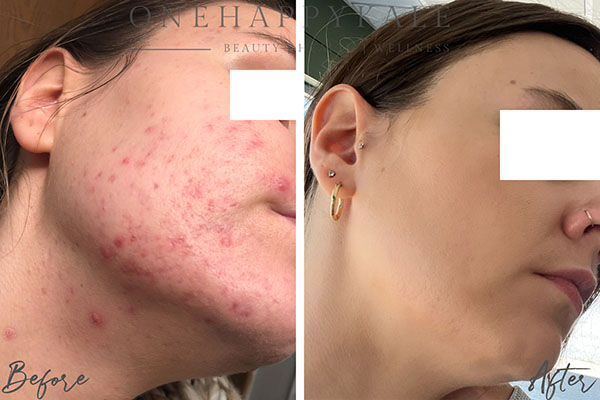 Client before and after, acne cleared