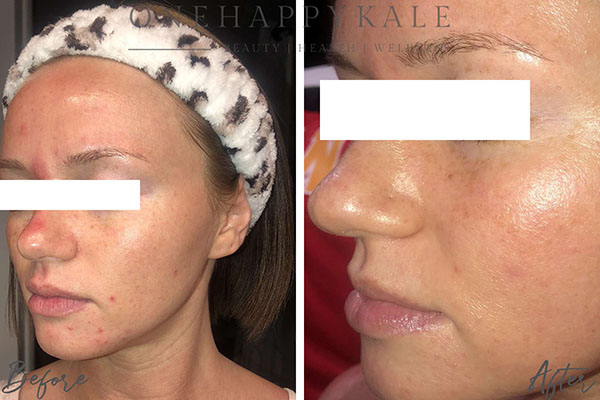 Client before and after, clearer skin