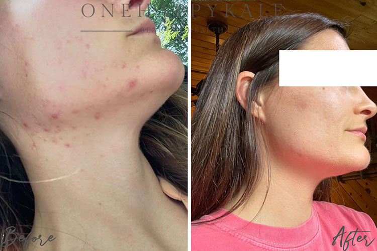 Client before and after, clearer skin