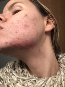 Michelle with cystic acne on her face