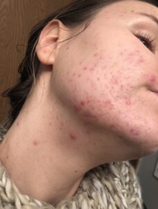 Michelle with cystic acne on her face